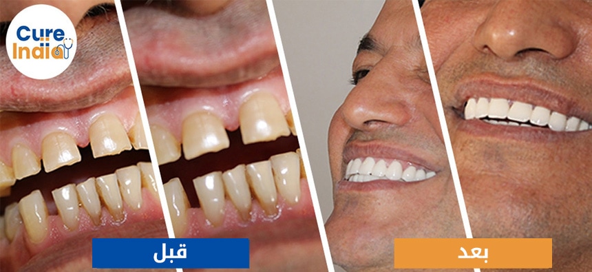 تلبيس الأسنان قبل وبعد الصور